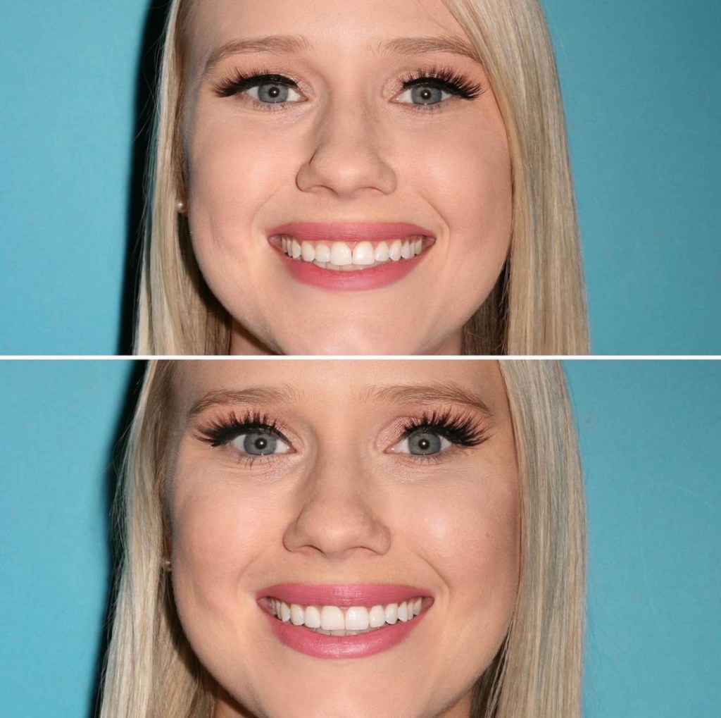 My smile before & after porcelain veneers